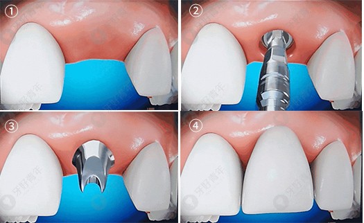 种植牙.jpg