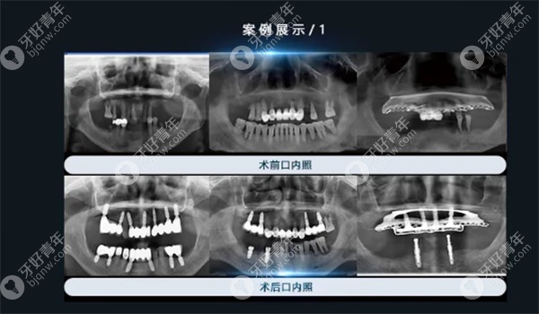 刘靖院长擅长做的种植手术