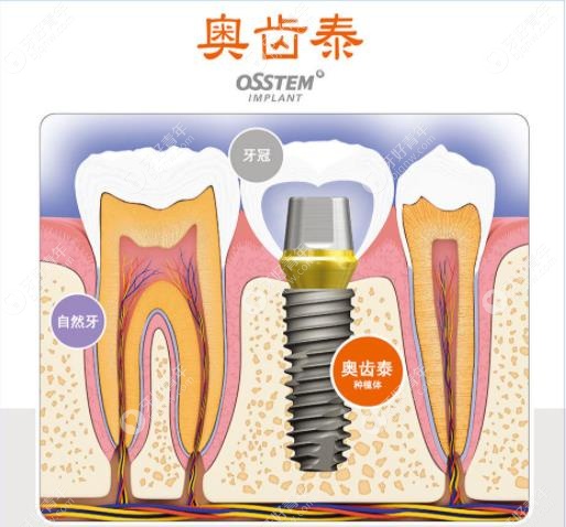 韩国奥齿泰OSSTEM