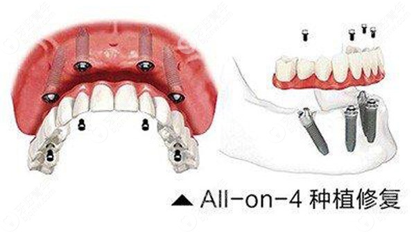 allon4全口种植修复